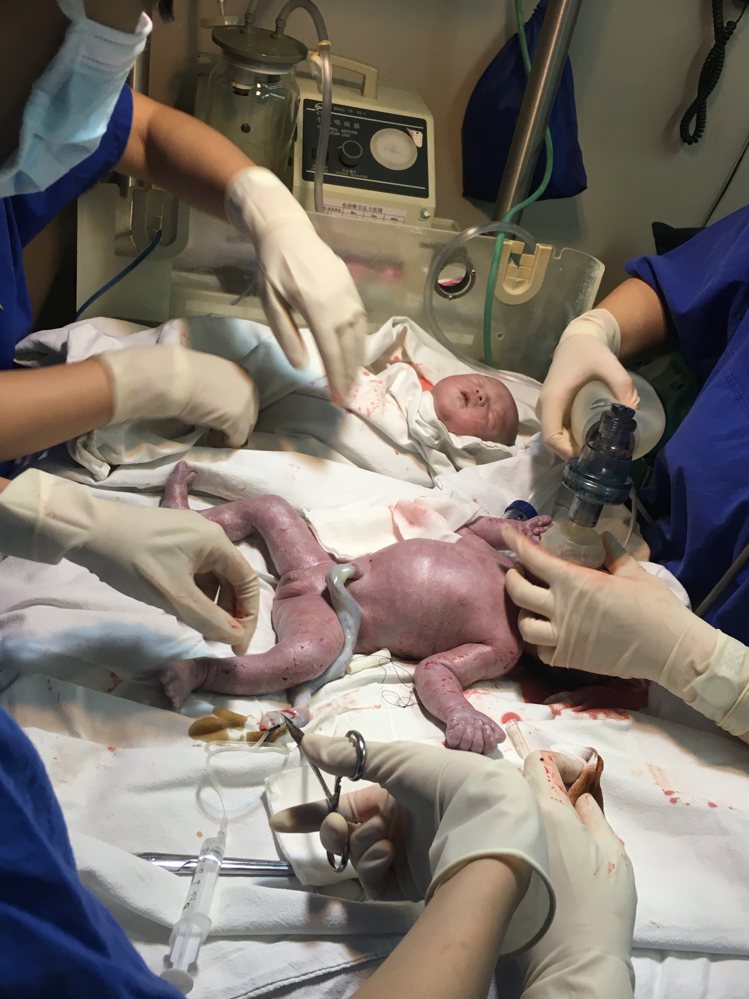新华妇产科成功为单绒单羊双胎孕妇剖宫分娩