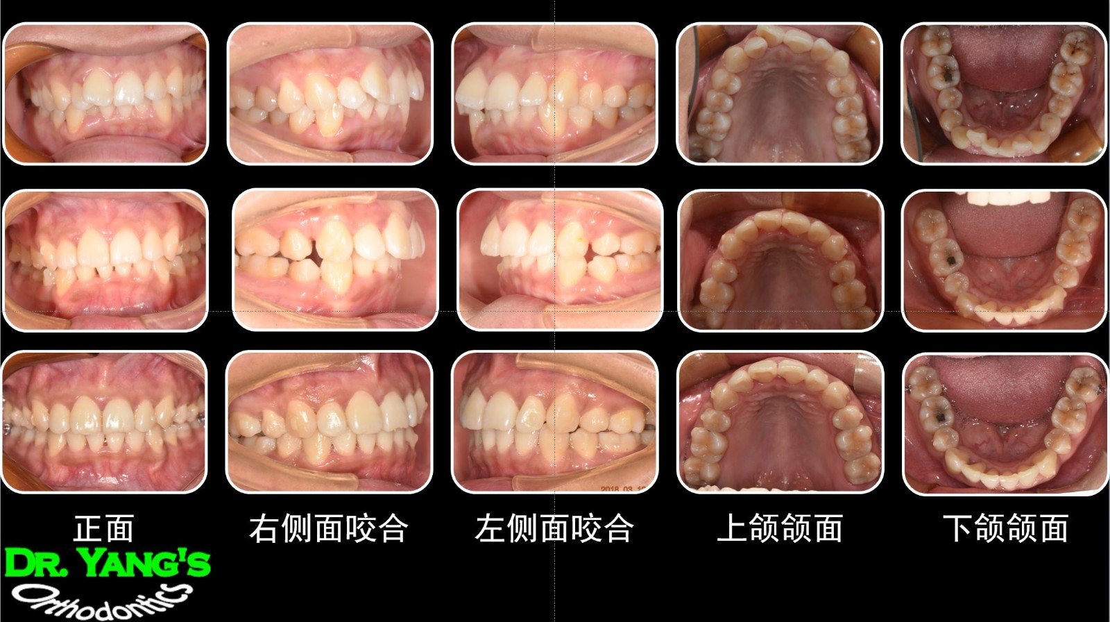 龅牙矫正全过程图片