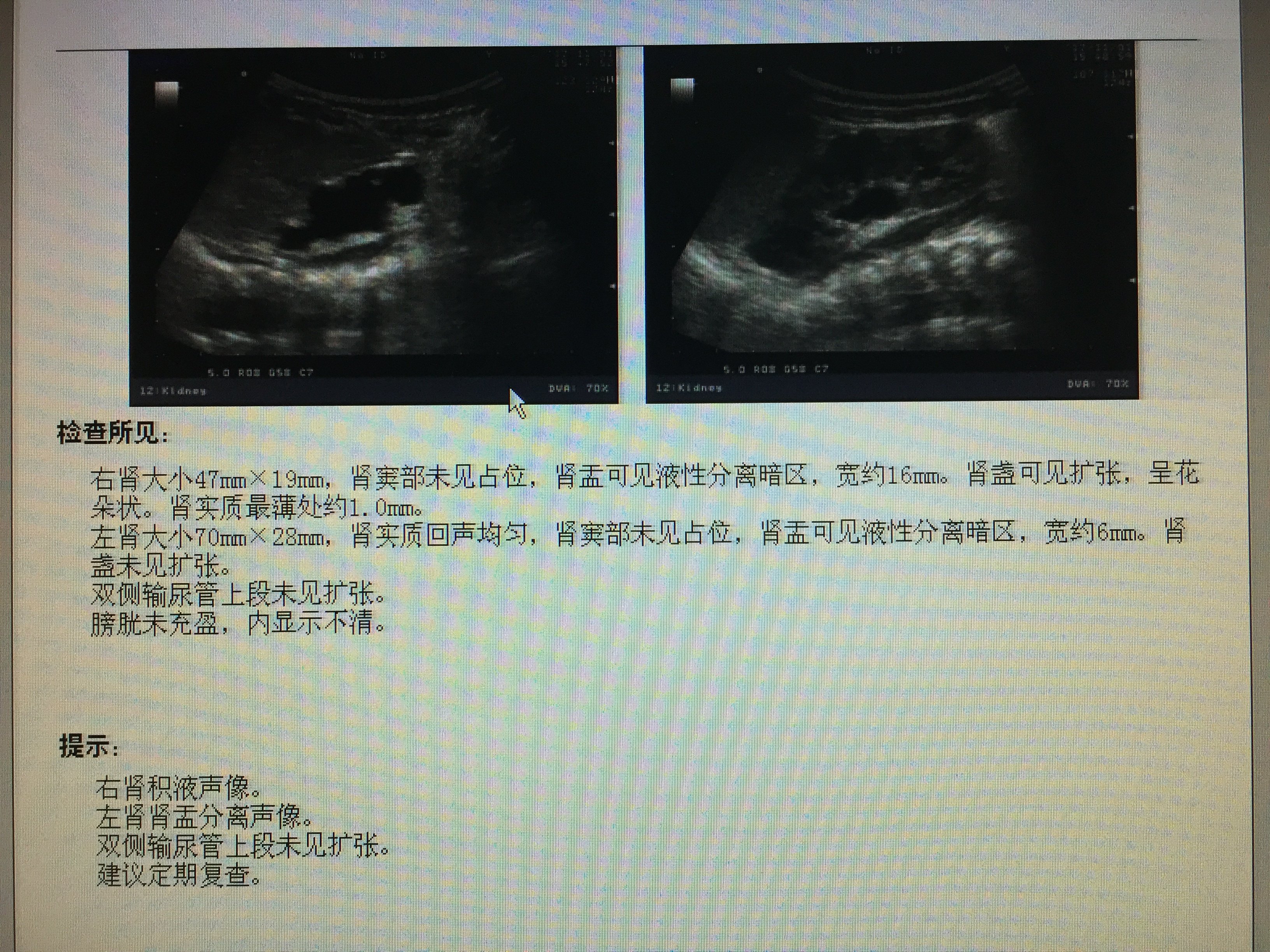 婴儿肾积水注意肾功能损伤严重的会肾萎缩