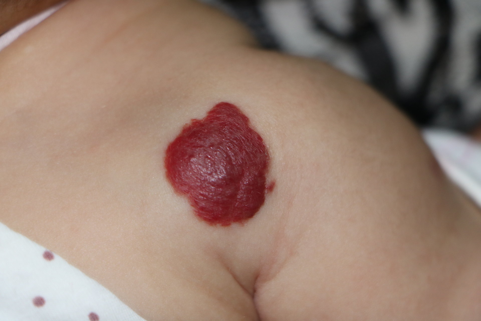 樱桃血管瘤 早期图片