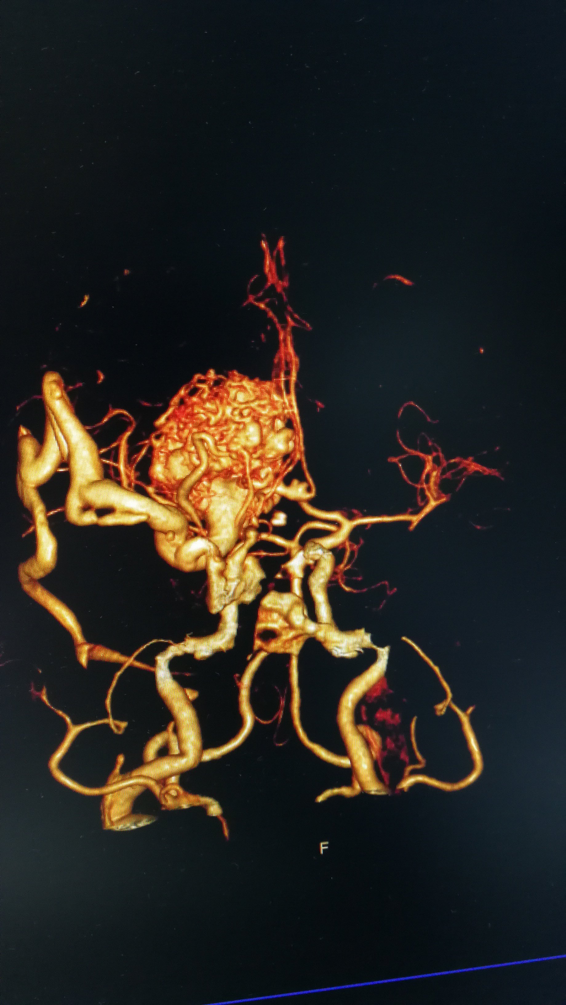 脑血管三维成像图片