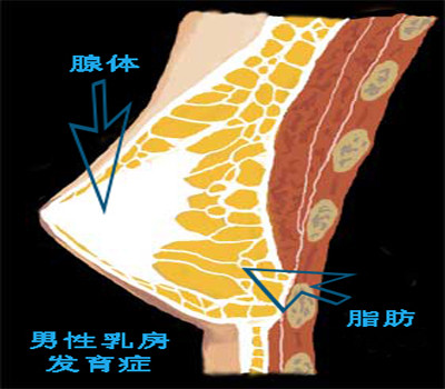 男性乳腺增生照片图片