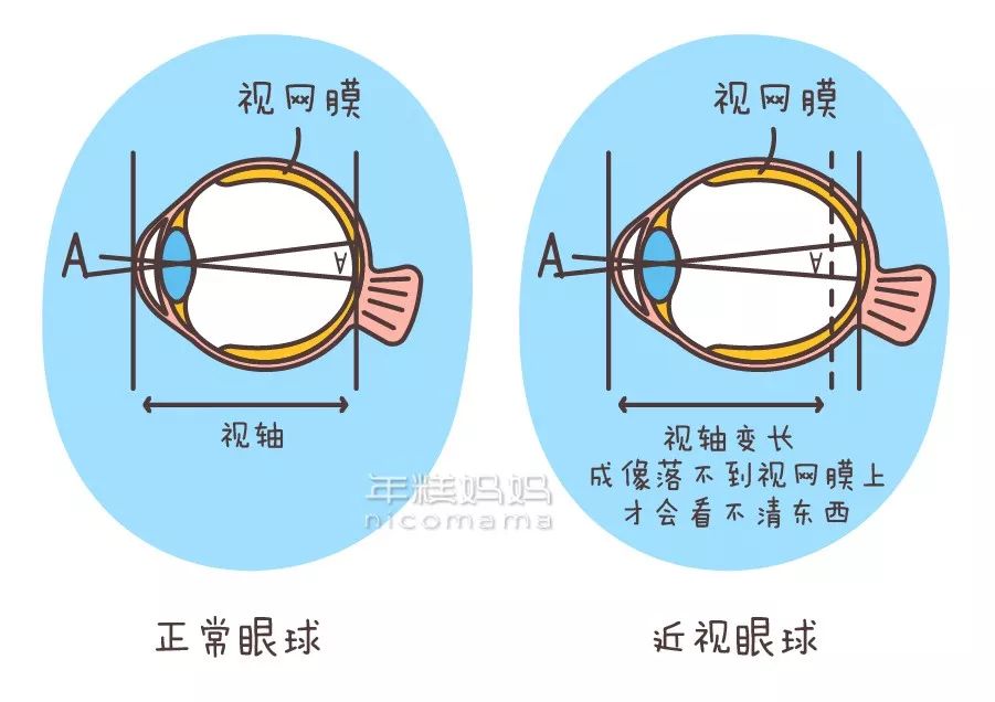 这是因为,阳光接触与眼球发育有关.