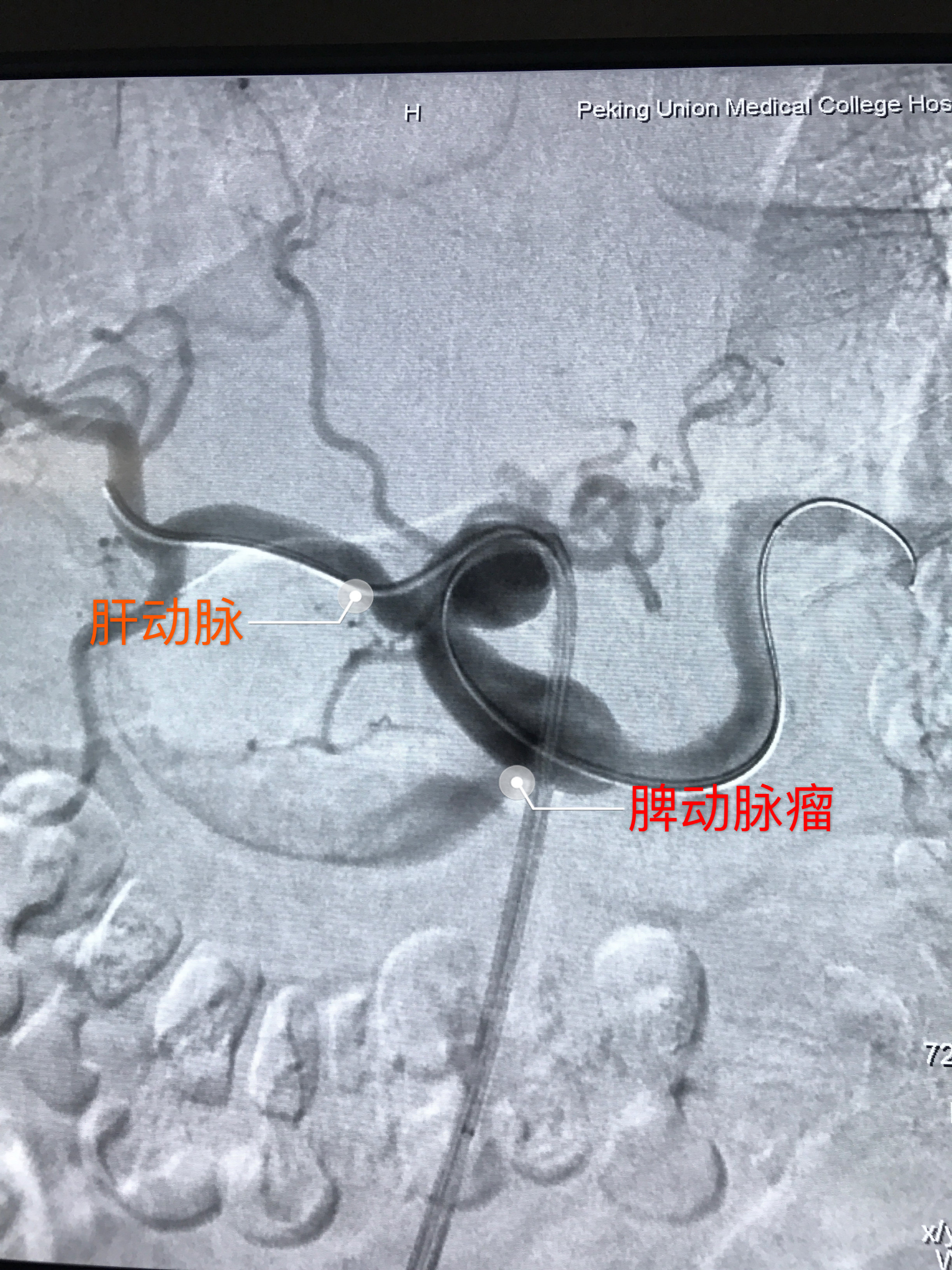 微創治療腹腔幹夾層和脾動脈瘤_肝動脈