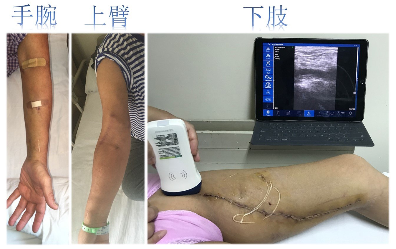 佘大夫談血液透析通路之7——內瘻可以在哪裡做?