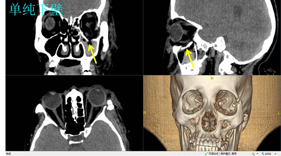 眉骨骨折图片ct图片
