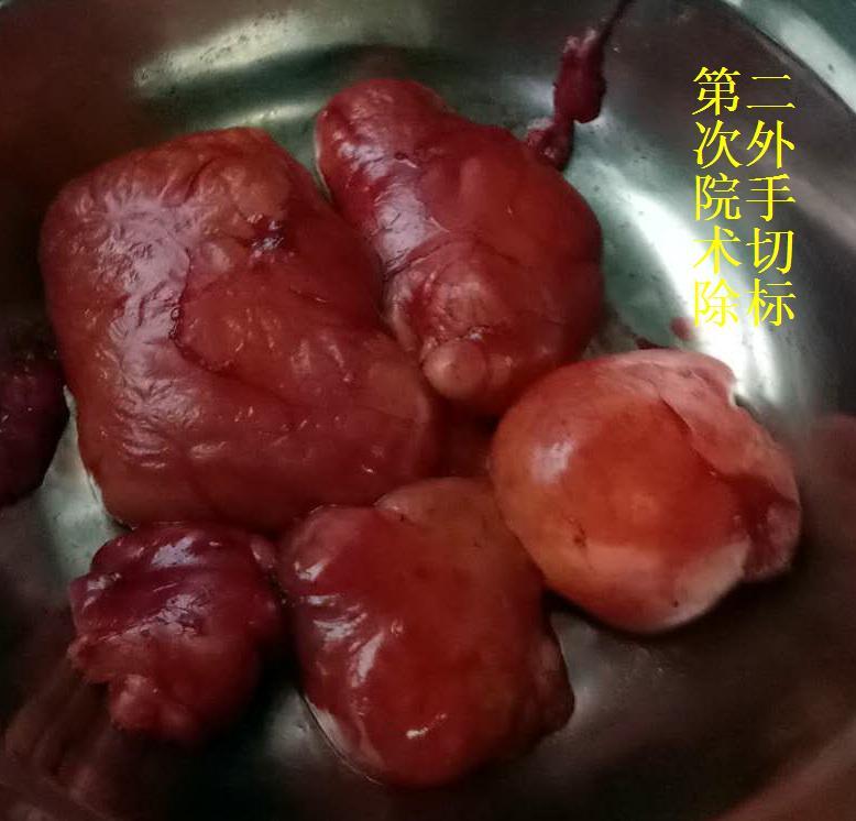 腹膜後脂肪肉瘤復發再手術切除