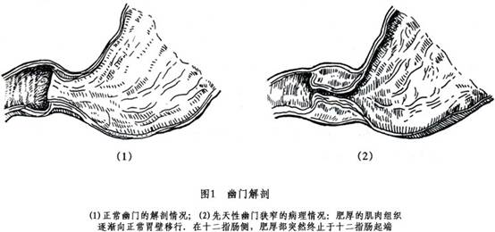 幽门环肌切开术示意图图片