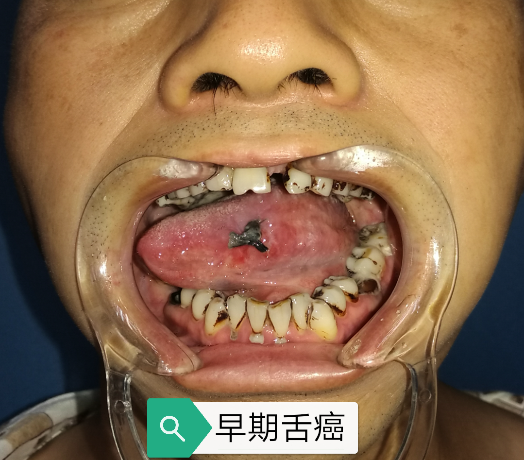 浸润性舌癌照片图片