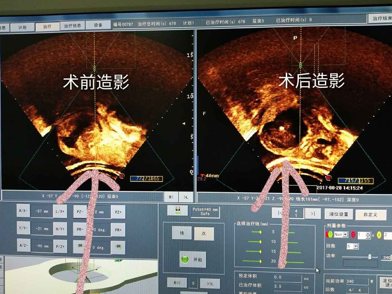 子宫肌瘤病历单图片图片