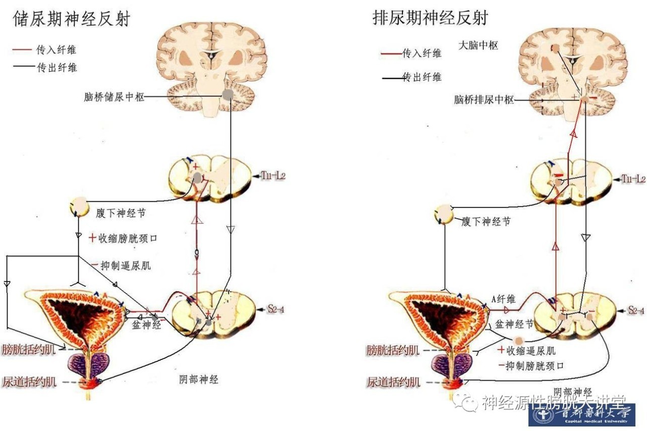 膀胱起搏器能恢复完全脊髓损伤患者的排尿功能吗转载