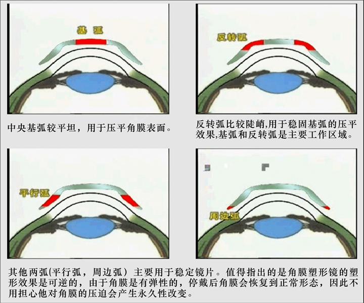 角膜塑形镜原理示意图图片