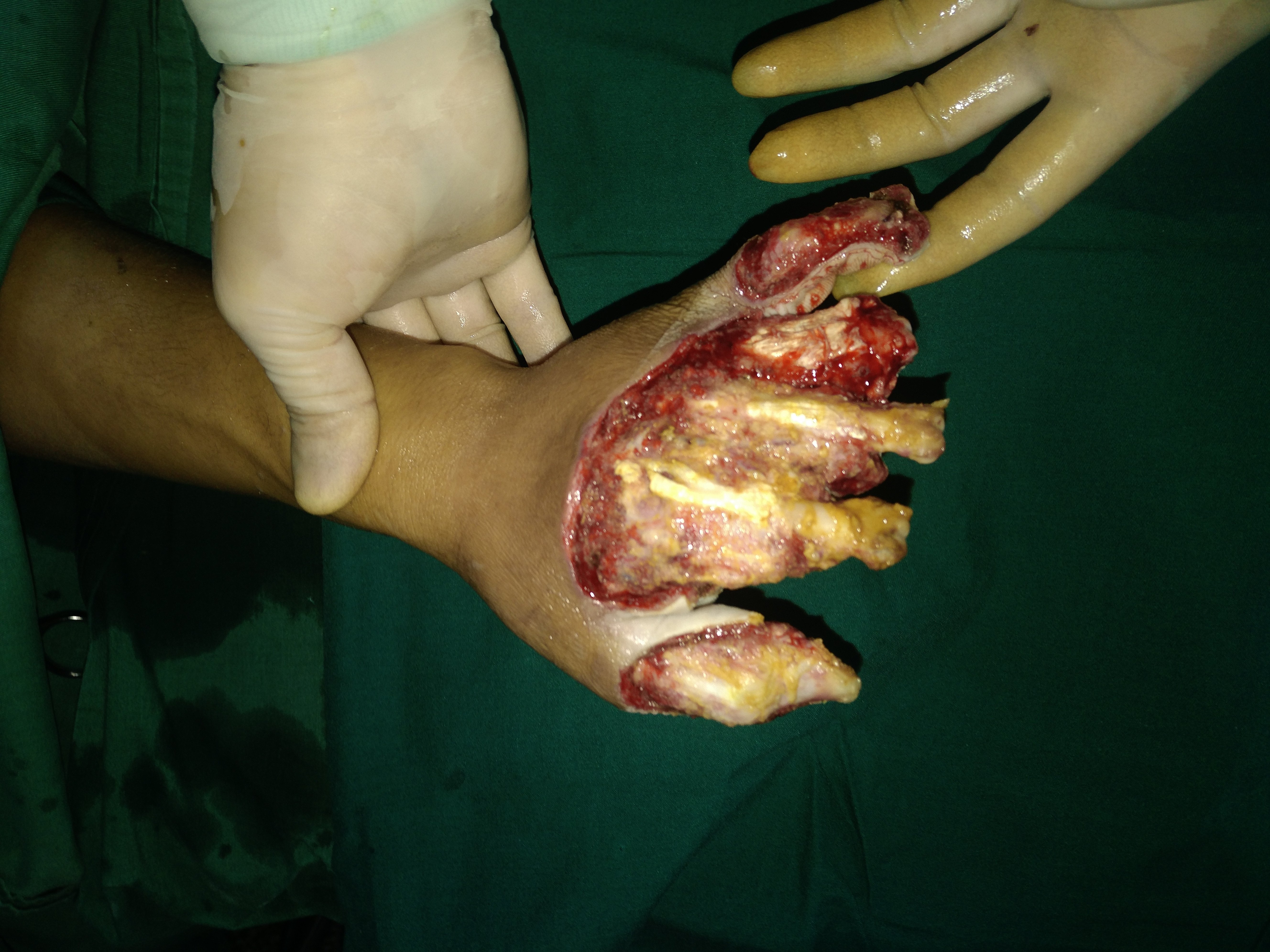 最近做的手术双手热压伤一次三个游离皮瓣修复创面