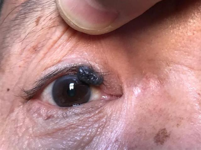 眼睑恶性黑色素瘤图片图片