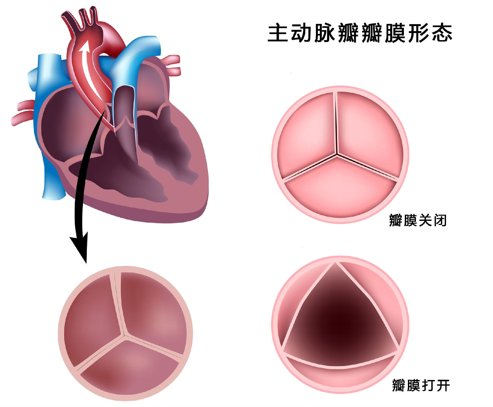 主动脉瓣是位于左心室和主动脉之间的心脏瓣膜,由3个半月瓣组成,每个