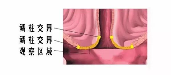 所谓 柱状上皮外翻是指女性宫颈口外部的鳞状上皮和宫颈内侧的柱状