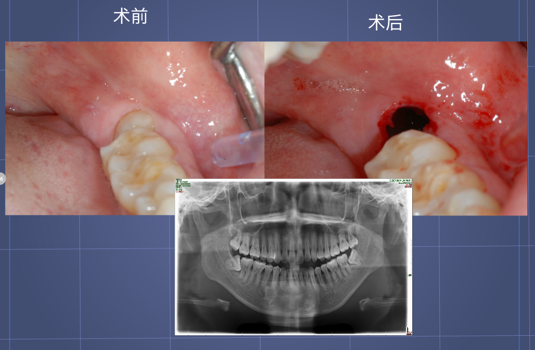 埋伏智齒的不翻瓣拔除!