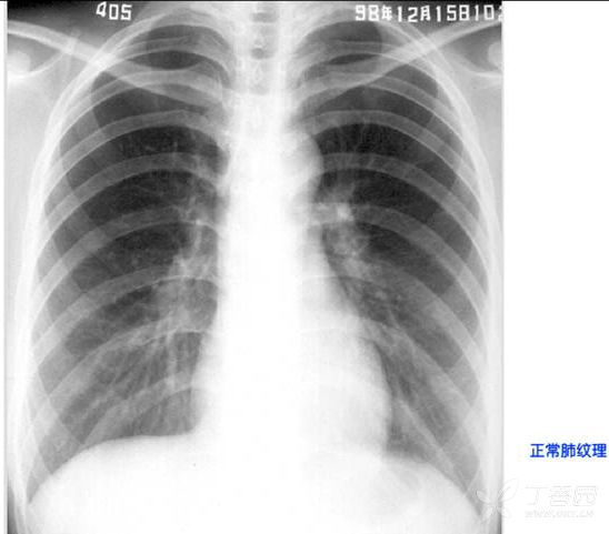 液氣胸的x射線表現照片名稱:肺內鈣化照片名稱:熊內甲狀腺腫照片名稱