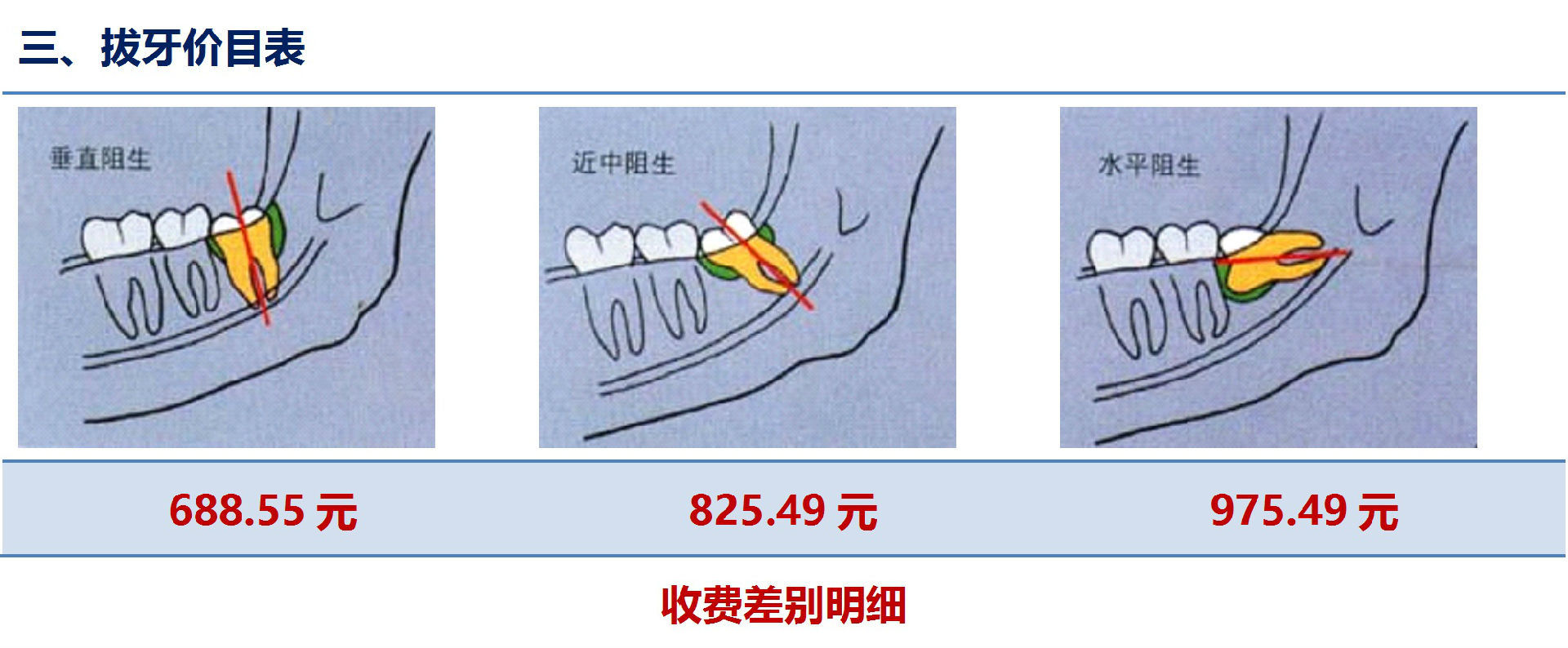 拔智齿收费标准图片