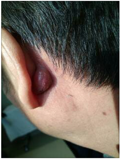 耳朵长粉瘤图图片