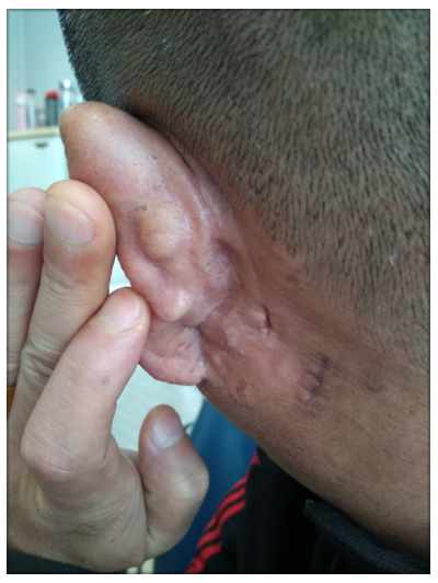 耳朵上的恶性肿瘤图片图片
