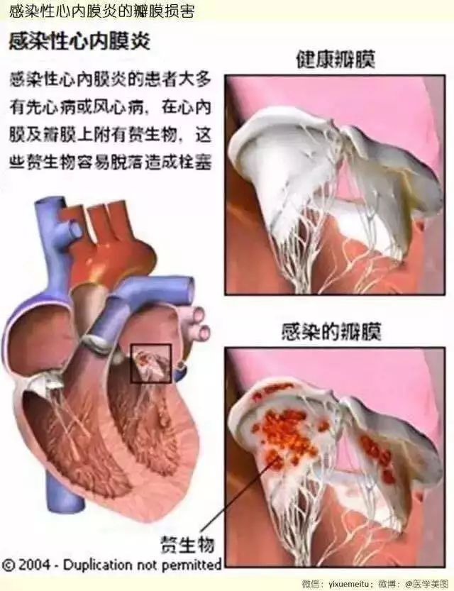 心脏赘生物的惊险之旅