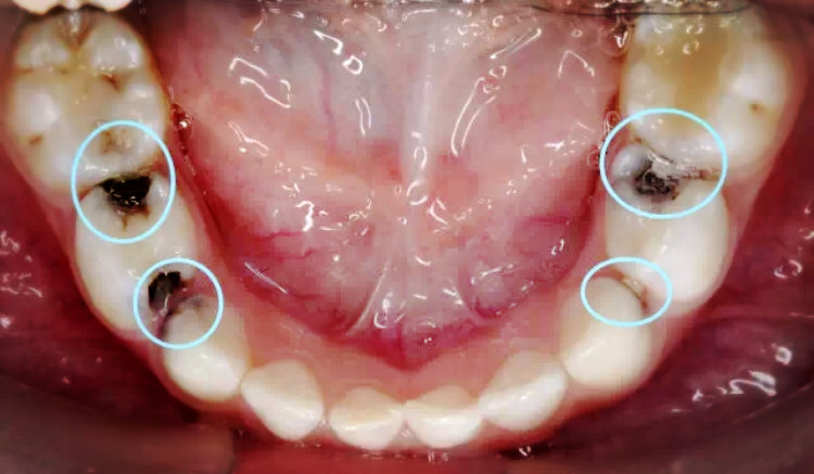 儿童邻面龋图片