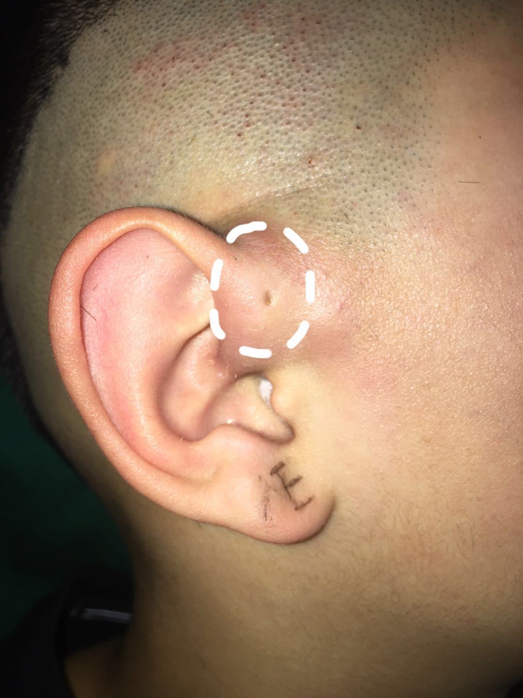 先天性耳瘘图片图片