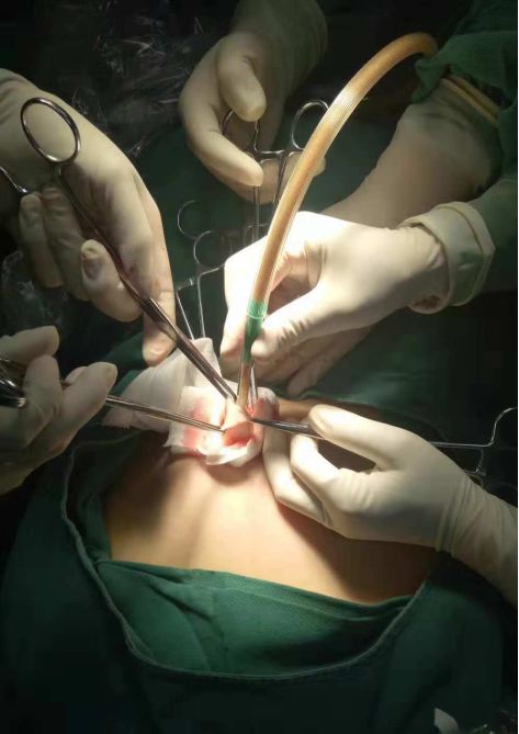 女性尿道手术开刀图片