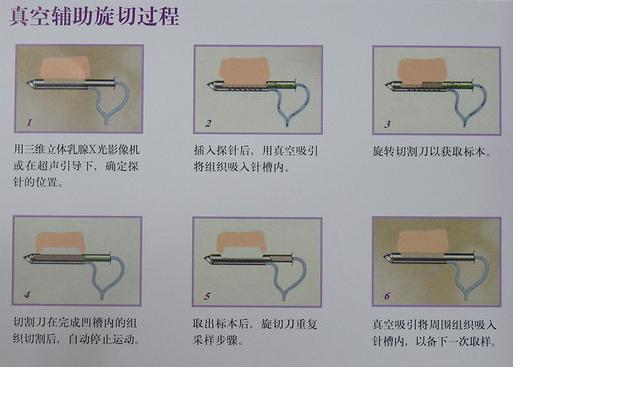 麦默通乳腺微创手术图片