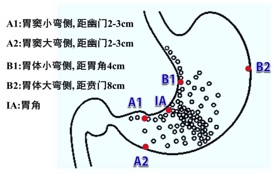 4,活检:在胃角,胃窦距幽门 2-3cm 的大弯侧和小弯侧,胃体距贲门 8cm