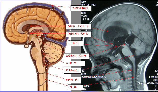 三脑室与四脑室解剖图图片