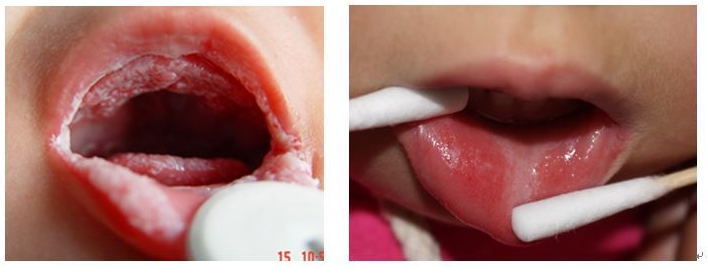 口腔假膜是什么样的图片