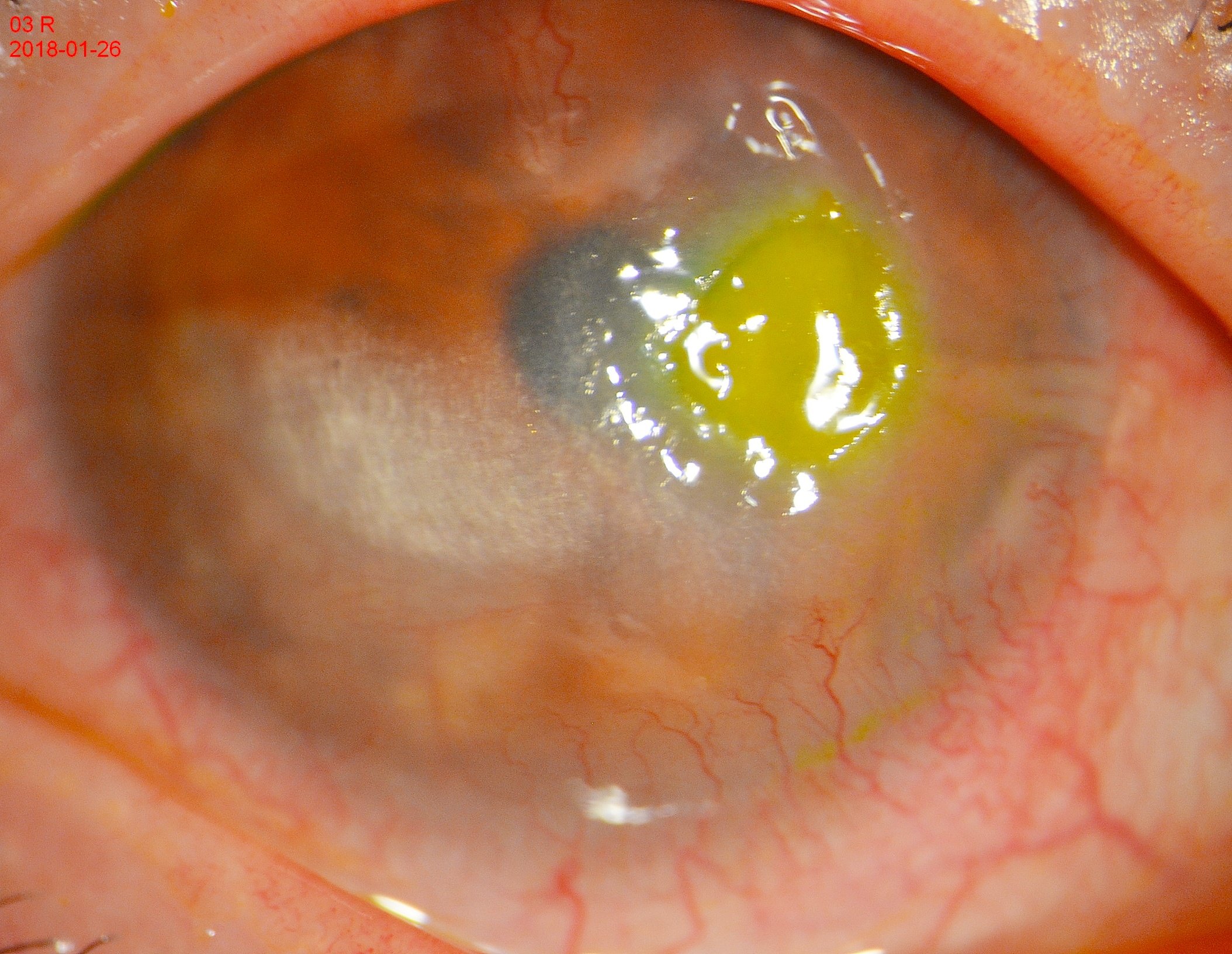 角膜炎溃疡的症状图片图片