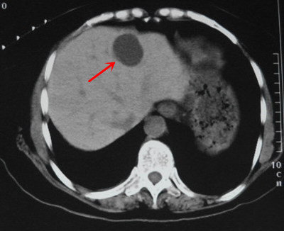 肝囊肿ct表现图片