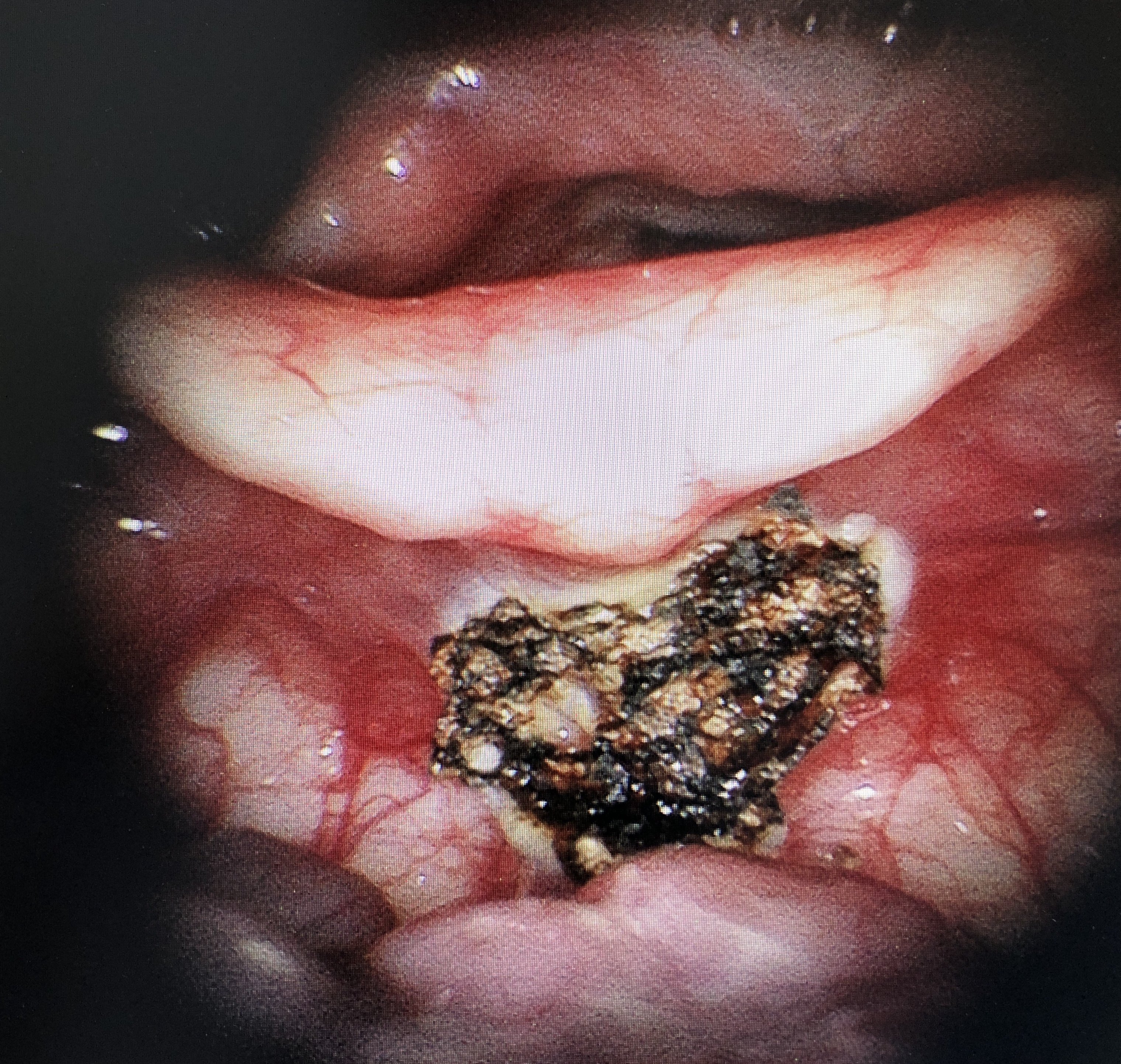 电子喉镜下可以看到会厌舌面中份及偏左两处大小不等囊肿样物