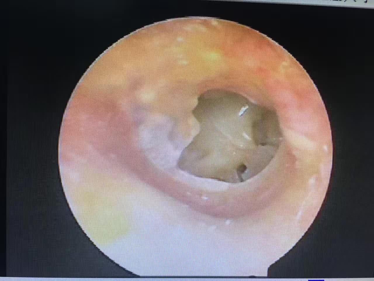 耳鼓膜穿孔术前与术后二十天对比照片