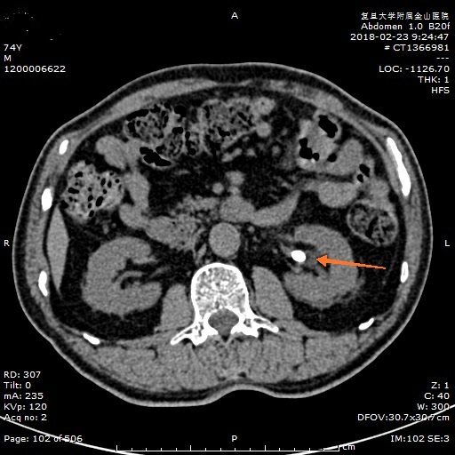 肾结石影像图片大全图片