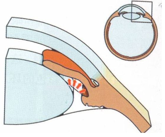 acg患眼瞳孔阻滯和房角關閉的關鍵因素之一,pacg患眼晶狀體較正常人厚