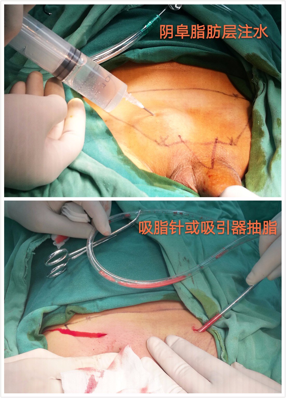 韩式微雕包茎手术图片