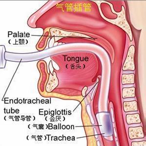 气管插管解剖示意图图片