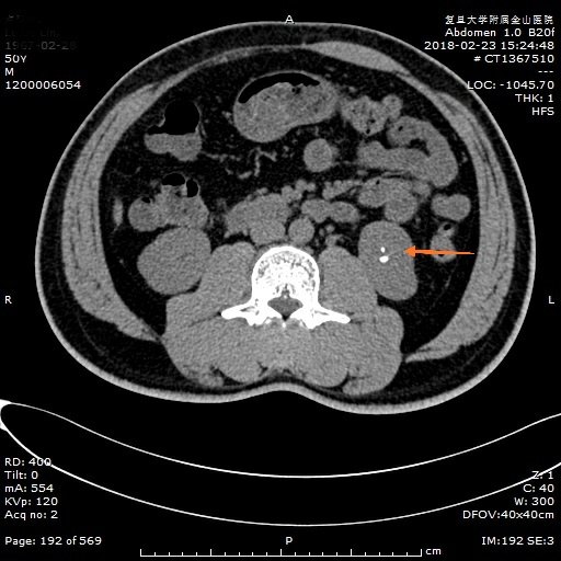 泌尿系統結石之腎結石ct表現_腎臟