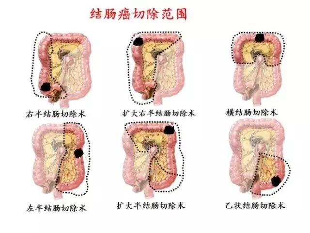 横结肠癌症状图片