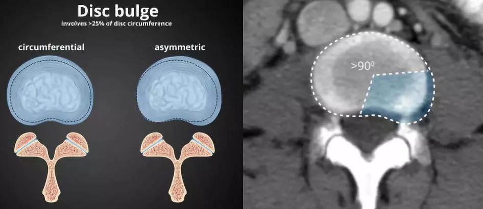 2分鐘教你快速鑑別椎間盤膨出,突出與脫出_纖維