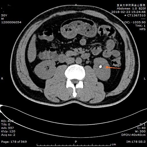 输尿管结石ct图解读图片
