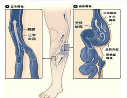下肢静脉曲张的危害与治疗