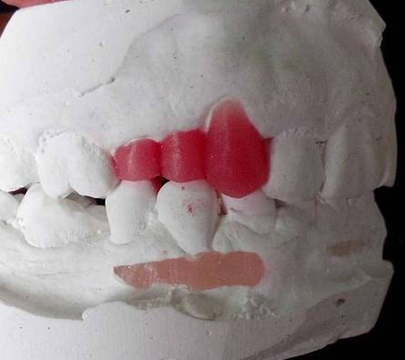 中切牙雕牙的步骤图解图片