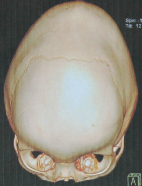 狭颅症的颅骨再造术(附两例病例)