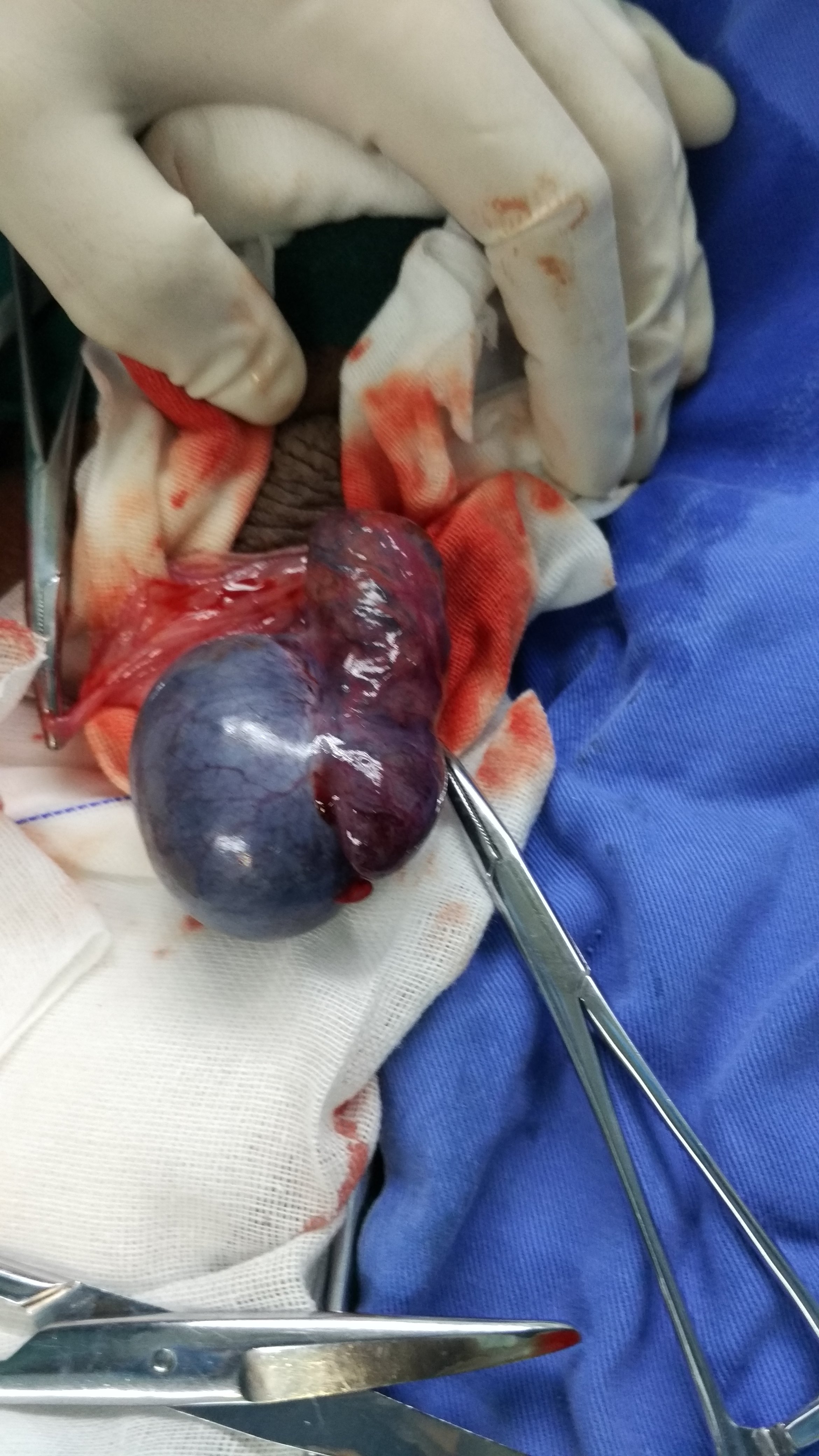 睾丸切除手术费用图片