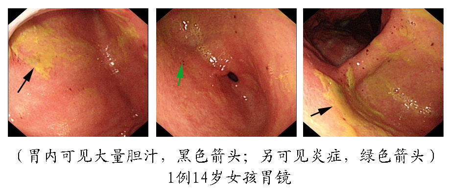 重度慢性浅表性胃炎图片